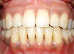 Fig 13. Après traitement orthodontique : La limitation de la traction du frein a assuré une cicatrisation meilleure des tissus parodontaux et une stabilité des résultats 