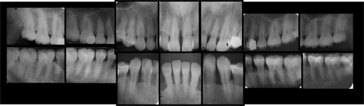 Fig 2 : Bilan radiographique. Notez la prédominance des lyses angulaires  de profondes à terminales au niveau du groupe incisivo-canin  inférieur, et la présence d’une lyse angulaire profonde entre 11 et 21