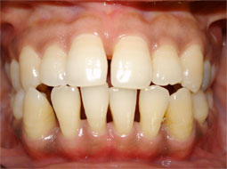 Fig 3 : État parodontal à 3 mois de la thérapeutique initiale : Notez l’amélioration des caractéristiques de la gencive et le rétrécissement spontané du diastème secondaire inter-incisif entre 11-21