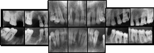 Fig 15 : Bilan radiologique. Notez la sévérité de l’atteinte  parodontale entre 41et 31, et entre la 11 et 12, ainsi que la prédominance des lyses angulaires 