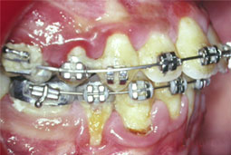 Fig. 7 : Conséquences d'une hygiène bucco-dentaire insuffisante