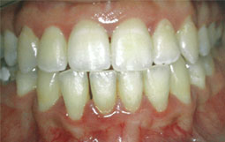 Fig. 1 : Zones de déminéralisation apparues à la fin du traitement orthodontique  