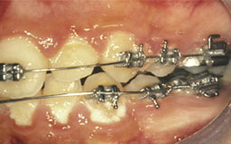 Fig. 2: Accumulation de plaque autour de l'appareillage 