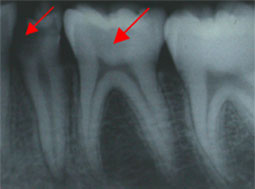 Fig.  4 :  Rétro-alvéolaire montrant le degré d'atteinte de la prémolaire et une carie surprise sur la première molaire 