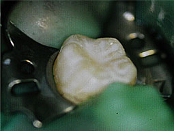 Fig. 5 : Le scellement des puits et fissures permet de réduire les anfractuosités occlusales