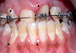 Fig. 6 : Apparition de taches de déminéralisation au cours d'un traitement orthodontique ayant nécessité la dépose de l'appareillage
