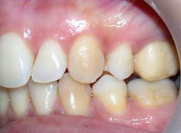 Fig 19 : Reprise de traitement orthodontique ;  problème de position mandibulaire de fin de traitement orthodontique. 