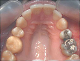Fig 20 : Reprise de traitement orthodontique ;  problème de position mandibulaire de fin de traitement orthodontique. 