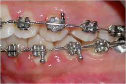 Fig10 : Collage segmenté à la mandibule : installation du guide antérieur puis des secteurs latéraux un à un
