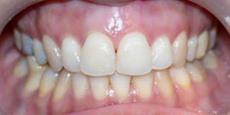 Fig 17 : Reprise de traitement orthodontique ;  problème de position mandibulaire de fin de traitement orthodontique. 