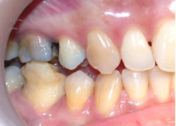 Fig 18 : Reprise de traitement orthodontique ;  problème de position mandibulaire de fin de traitement orthodontique. 