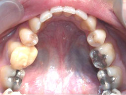 Fig 21 : Reprise de traitement orthodontique ;  problème de position mandibulaire de fin de traitement orthodontique. 
