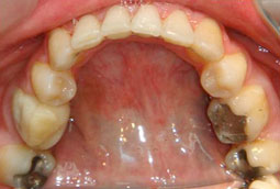 Fig 26 : L’occlusion de fin de traitement, installation de l’occlusion dans la position thérapeutique choisie.  