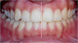 Fig 35 : L’occlusion de fin de traitement, installation de l’occlusion dans la position thérapeutique choisie.