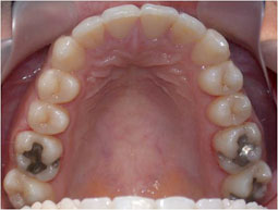 Fig 38 : L’occlusion de fin de traitement, installation de l’occlusion dans la position thérapeutique choisie.