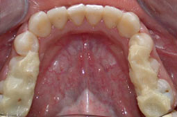 Fig4 : Cales stabilisatrices réalisées à l'arcade mandibulaire