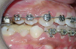 Fig9 : Collage segmenté à la mandibule : installation du guide antérieur puis des secteurs latéraux un à un