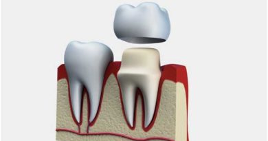 Les couronnes dentaires : Ce qu’il faut savoir