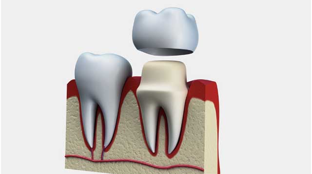 Tout savoir sur les couronnes dentaires