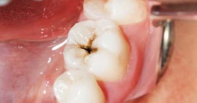 Les caries dentaires : causes et traitements