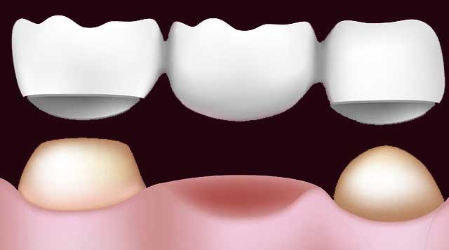 Bridges dentaires : Avantages et inconvénients