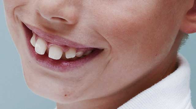 Traitement orthodontique précoce chez l’enfant