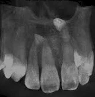 Radiographie occlusale