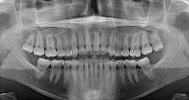 Type de radiographie dentaire: la panoramique
