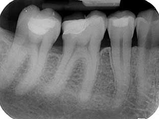 Radiographie périapicale