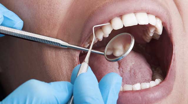 Tartre sur les Dents : Comment s'en Débarrasser ou le Prévenir?