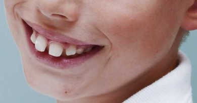 Traitement orthodontique précoce chez l’enfant