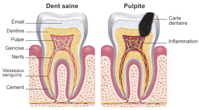 Qu'est-ce qu'une pulpite dentaire ?