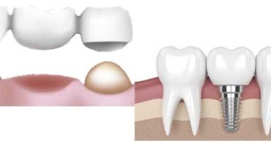 Quel choix entre implant dentaire et bridge ?