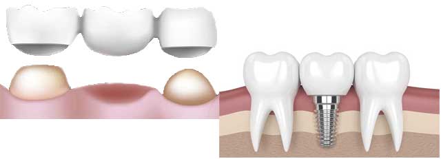 Quel choix entre implant dentaire et bridge ?