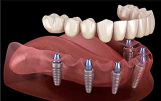 Prothèses dentaires sur implants