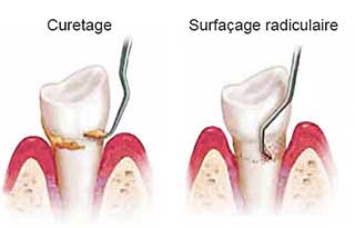 curetage et surfaçage