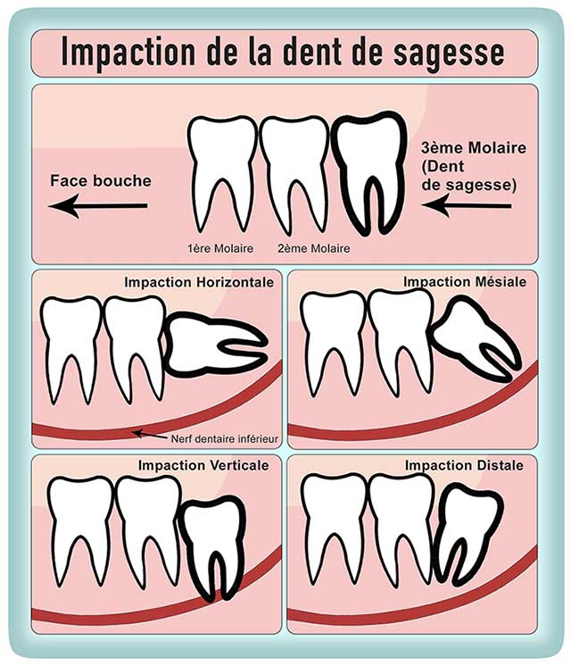 Extraction de la dent de sagesse: quand et pourquoi ?