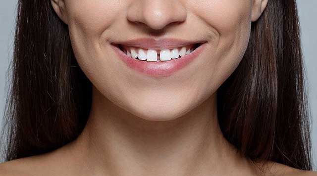 Diastème ou dents du bonheur