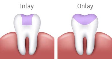 Inlay et onlay: 2 options d'obturation indirectes