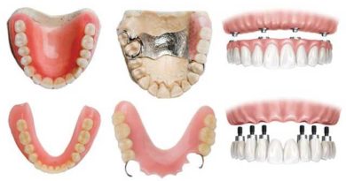 Types de prothèses dentaires