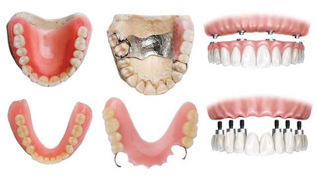 Types de prothèses dentaires - Ma santé bucco-dentaire