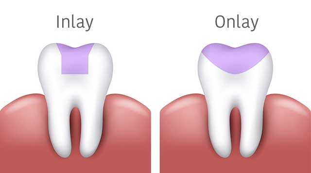 Inlay et onlay: 2 options d'obturation indirectes