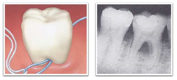 Implantation de la furcation