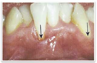 Atteinte MucoGingivale (MGI)