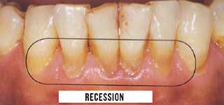 récession gingivale