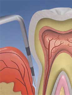 Sondage parodontal