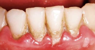 Qu'est-ce que la plaque dentaire et comment l'éliminer ?