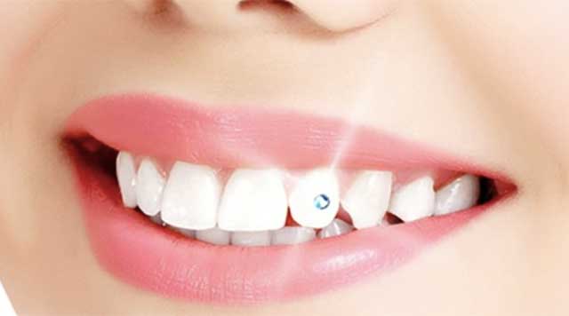 Bijoux dentaires : sont-ils nocifs pour la santé des dents ?