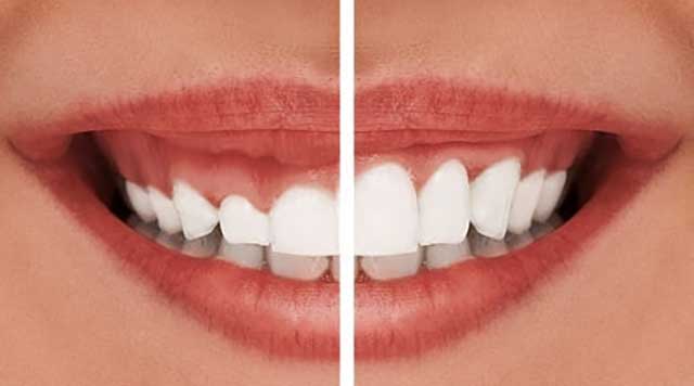 Comment réparer mon sourire gingival ?