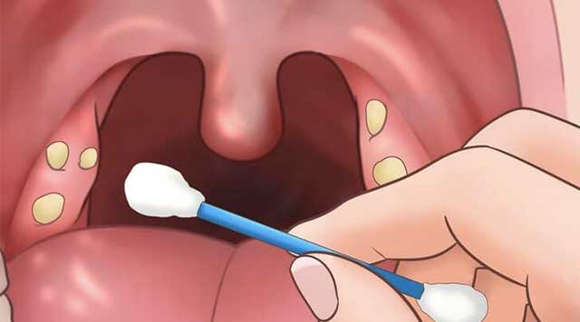 □Le CASEUM???? Le caséum, qui siège au niveau des amygdales, est une  affection généralement bénigne de l'appareil buccal. Fréquemment à  l'origine de la, By Médecine